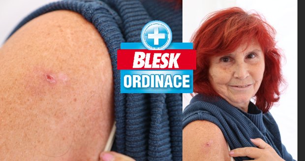 Ireně (61) pomohla Blesk Ordinace: Z nenápadného stroupku se vyklubal nádor! Co dalšího prevence ukázala?