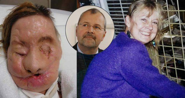 Chirurg Pomahač ženě transplantoval obličej, její tělo ho odmítalo, teď promluvila