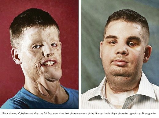 2011 - Mitch Hunter naboural do sloupu vysokého napětí a výboj mu sežehl obličej. Tým dr. Pomahače mu rekonstruoval celý obličej.