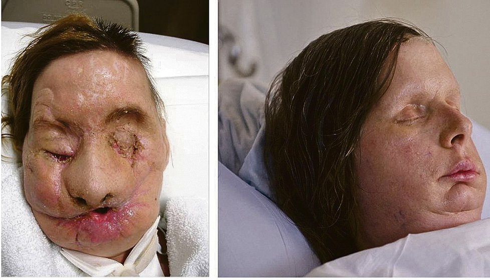 Charle Nash utrhl šimpanz tvář, a navíc obě ruce. Po třech letech jí tým Bohdana Pomahače transplantoval obličej.