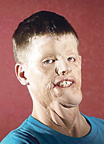 Vážnou nehodu prožil v roce 2001 Mitch Hunter z Indiany. Jeho vůz naboural do sloupu vysokého napětí, které mu spálilo obličej.
