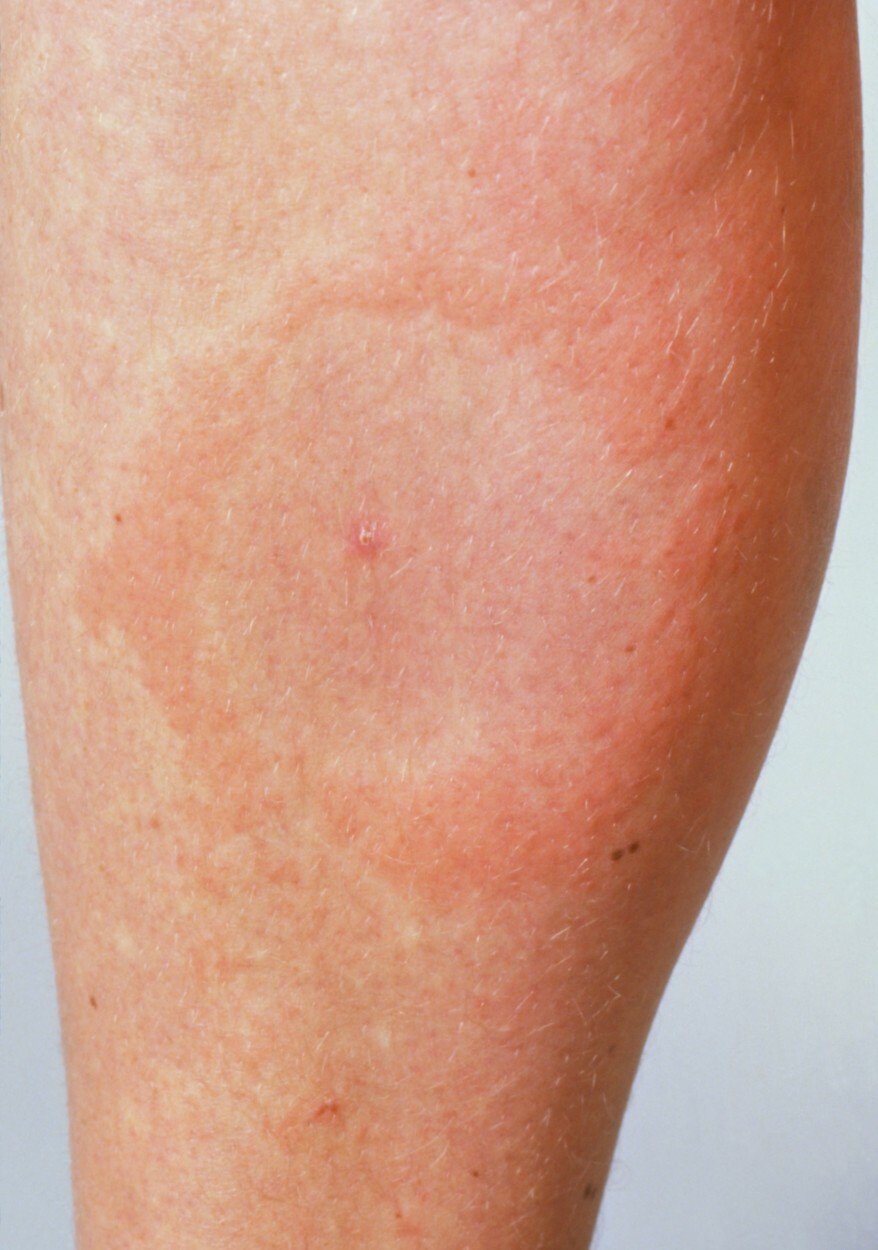 Červené místo s bílým flekem uvnitř - typický příznak boreliózy (ilustrační foto)