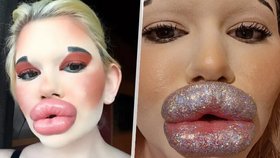 Andrea si libuje v botoxových výplních.