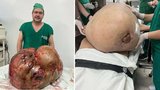 Chirurg vyoperoval drobné ženě nádor vážící 46 kilo: V těle ho měla pět let!