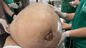Chirurg Glaucio Boechat se svým týmem vyoperoval ženě nádor vážící 49 kilogramů!