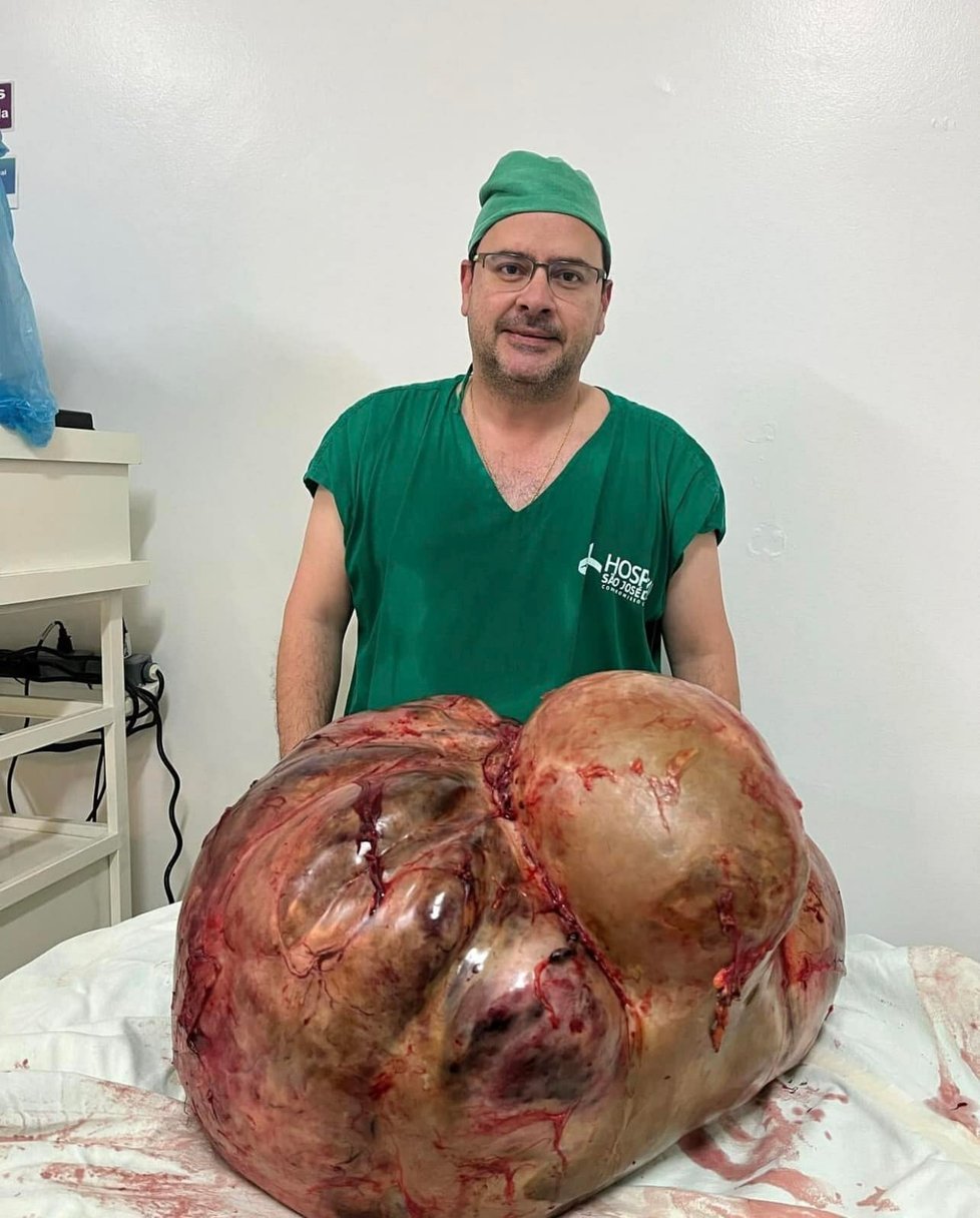 Chirurg Glaucio Boechat se svým týmem vyoperoval ženě nádor vážící 49 kilogramů!