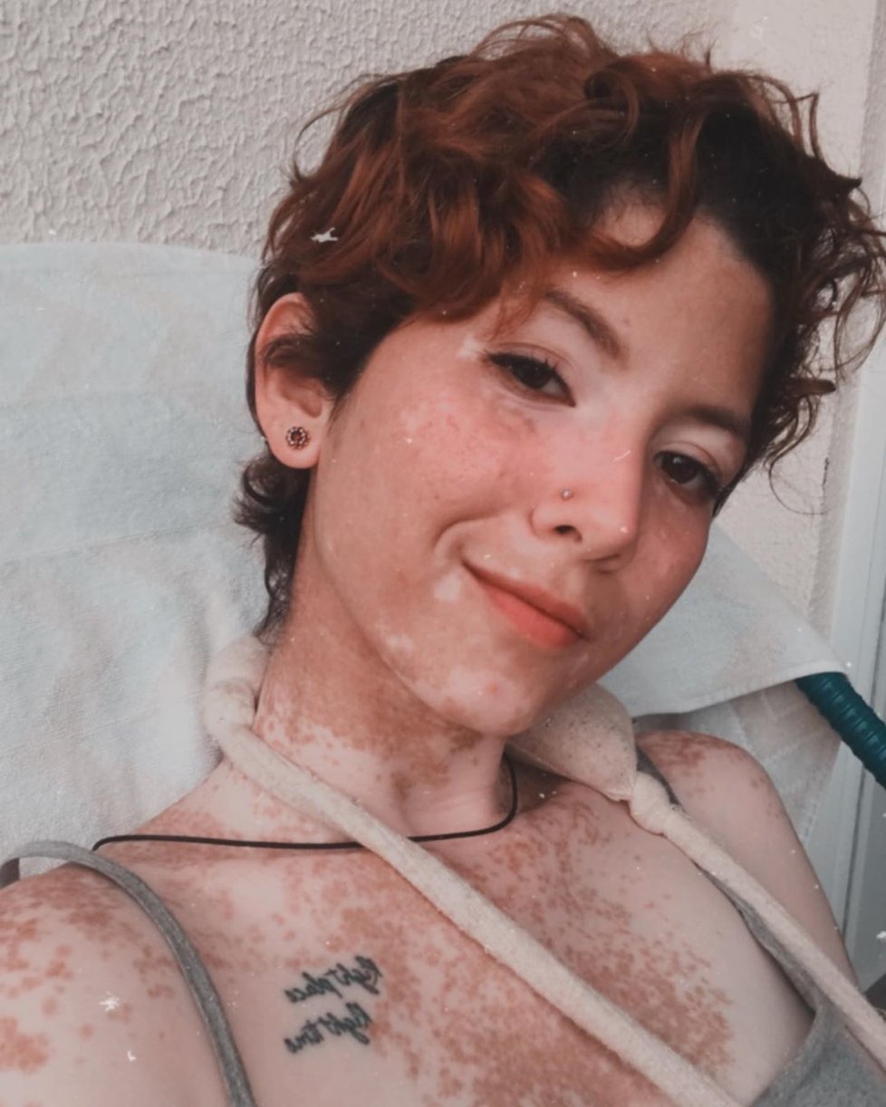 Modelku (21) kvůli kožní nemoci šikanovali: Naučila se milovat své tělo.