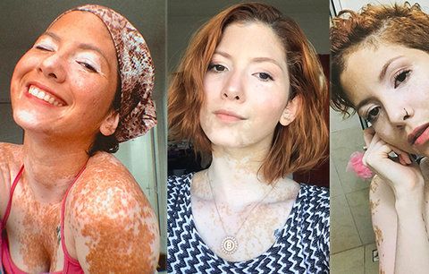 Modelku kvůli kožní nemoci šikanovali: „Ptali se mě, jaké to mám tam dole,“ říká
