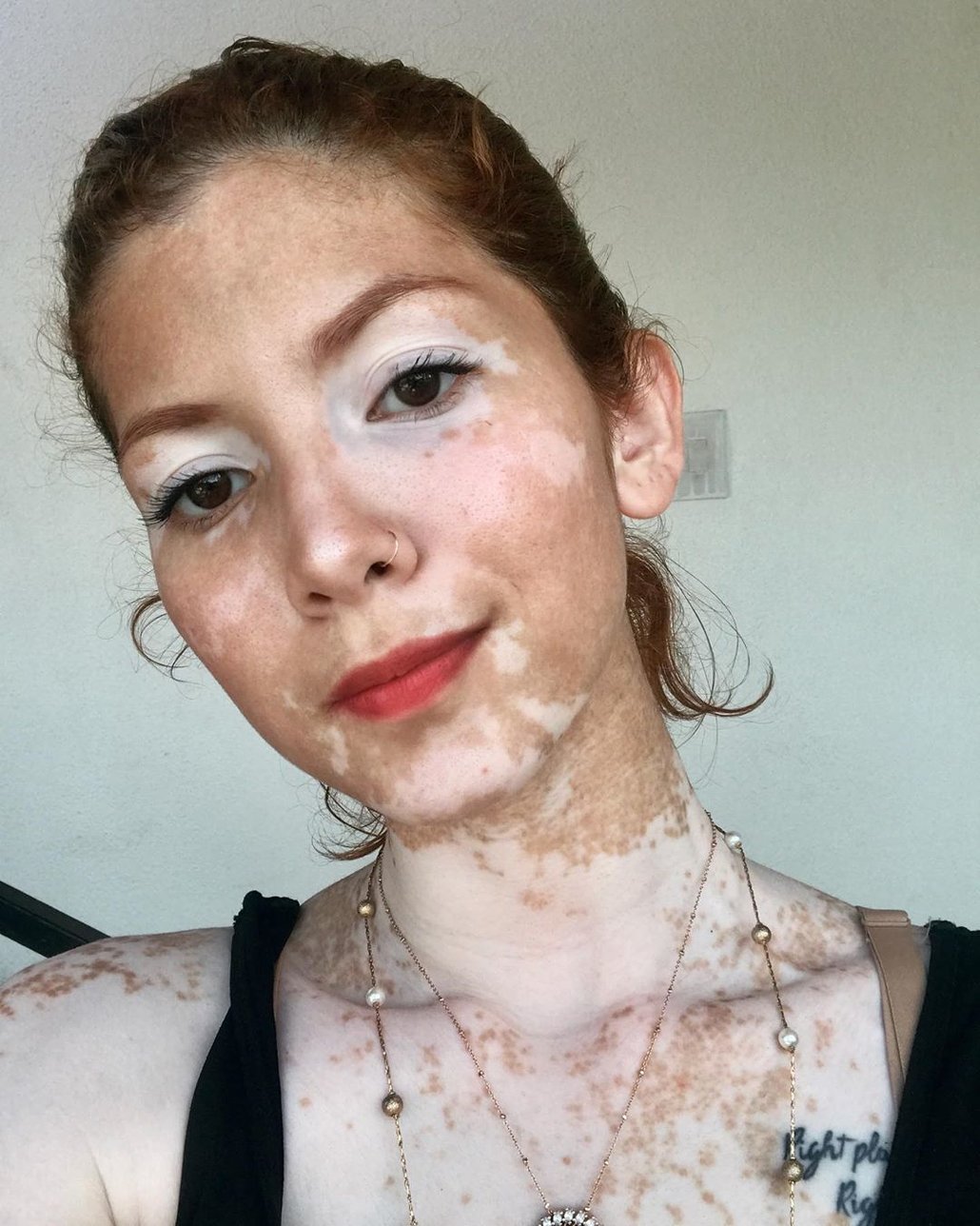 Jak vypadá vitiligo?