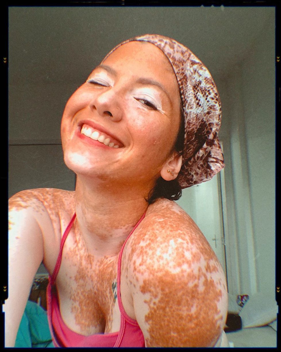 Modelku (21) kvůli kožní nemoci šikanovali: Naučila se milovat své tělo.