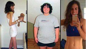 Rodiče už pro ni chystali pohřeb: Anorektička pak přibrala 70 kilogramů! 