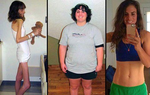 Rodiče už pro ni chystali pohřeb: Anorektička pak přibrala 70 kilogramů! 