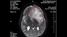 Brittany měla na mozku obrovský nádor.