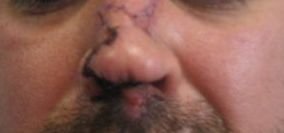 Muži (35) z Brna ukousl nos jeho opilý kamarád. Zpět na své místo mu ho přišili plastičtí chirurgové.