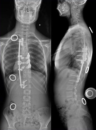 Rentgen po operaci skoliózy páteře novou metodou. Méně šroubů a jen jedno lanko. Páteř zůstává pohyblivá a může růst.