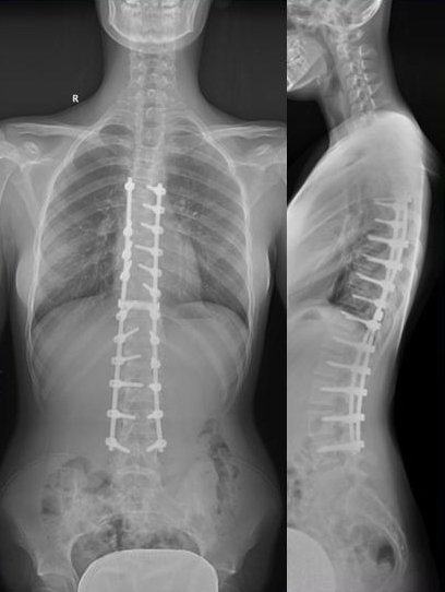 Rentgen po operaci skoliózy páteře starou metodou. Páteř je narovnána více šrouby a tyčemi.