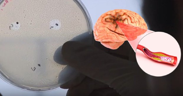 Vědci z Brna vyvinuli enzym, který dokáže účinně rozpouštět krevní sraženiny po mozkové mrtvici.