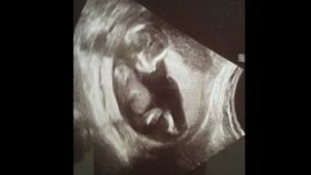 Ultrazvuk nastávající rodiče ujistil, že jejich dítě je v pořádku.