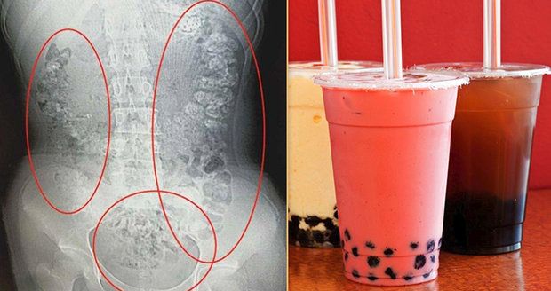 Dívku (14) trápily ukrutné bolesti břicha! Lékaři jí v břiše našli 100 kuliček z bubble tea
