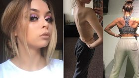 Casey Lees-Smithová (24) trpěla bulimií, kvůli poruše příjmu potravy vážila v devatenácti letech pouhých asi 32 kilogramů