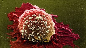 Rakovinná buňka