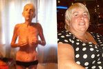 Obézní ženě podvázali žaludek: Prudká změna váhy ji málem zabila!