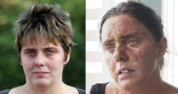 Mrazivá zpověď oběti kyselinového útoku: Proč se rozhodla ukázat svou tvář