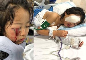 Cecilia Cheová (6) přišla při nehodě o oční víčko.