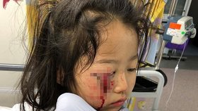 Cecilia Cheová (6) přišla při nehodě o oční víčko.