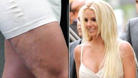 Britney Spears má také problémy s celulitidou.