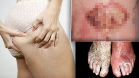 Onemocnění kůže zvané cellulitis může i zabíjet.