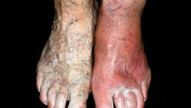 Cellulitis je anglické označení pro flegmónu. Na tu v roce 2014 zemřelo 42 osob.