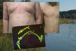 Desítka dětí si z koupání v Kolovském rybníku odnesla cerkariovou dermatitidu. (ilustrační foto)