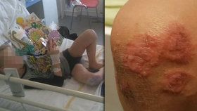 Děti se z Mořského koníka vrátily se salmonelou, úplavicí a impetigem. Hlavní vedoucí promluvil