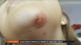 Děti se z Černé hory vrátily s vážnými zdravotními problémy včetně salmonely, úplavice nebo impetiga.