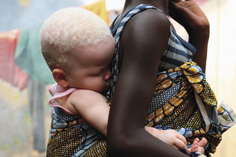 Albinotické děti se v Africe rodí častěji než v populaci bělochů