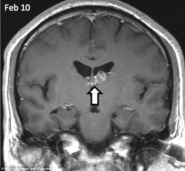 Muži se mozkem proháněl červ - žil mu v hlavě 4 roky!