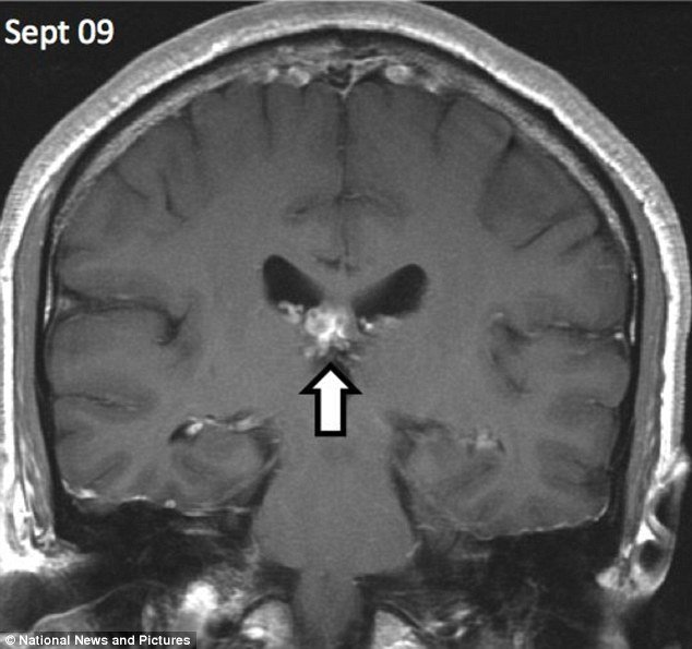 Muži se mozkem proháněl červ - žil mu v hlavě 4 roky!