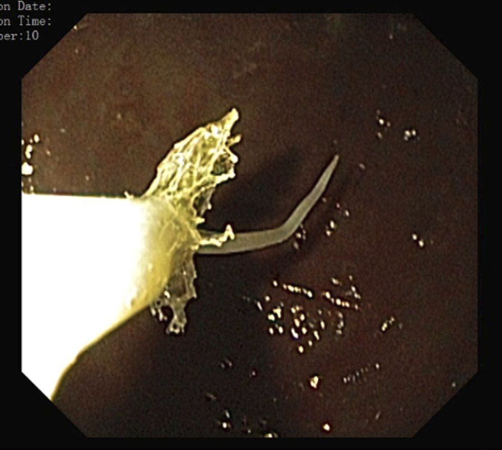 V pacientově žaludku endoskop odhalil bílého června přikousnutého na sliznici.