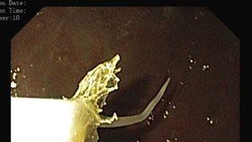 V pacientově žaludku endoskop odhalil bílého června přikousnutého na sliznici.Takto lékaři červa odstranili.