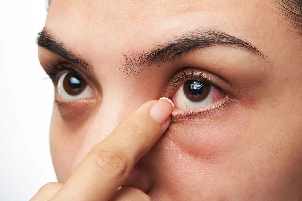 Jak se zbavit zarudnutí oči?