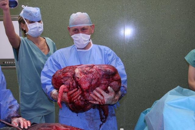 V nemocnici Tomáše Bati ve Zlíně odoperovali ženě 36 kg vážící nádor. O zákroku, který trval 7 hodin, informovala média v Anglii a USA.