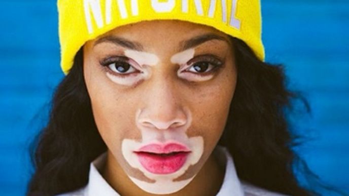 Chantelle Brown-Young trpí kožní chorobou zvanou vitiligo, přesto se jí podařilo prorazit v modelingu.