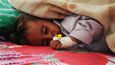 Akutní podvýživou trpí víc než 2 miliony dětí. Foto: Abdulhakim Ansi/CARE