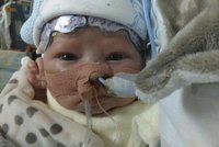 Lékaři transplantovali srdce osmitýdennímu miminku. Chlapec byl nejmladší na listině