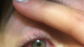 Chůva (24) oslepla na jedno oko: Komár jí vlétl do oka a zanesl tam infekci!
