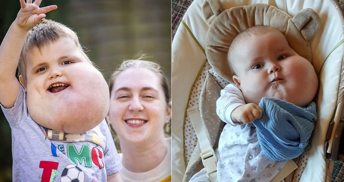 Chlapec trpí obří cystou.
