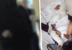 Měsíční chlapeček z Brna skončil s natřikrát zlomenou nohou a popáleninami v obličeji. Matka (vlevo) týrání popírá.