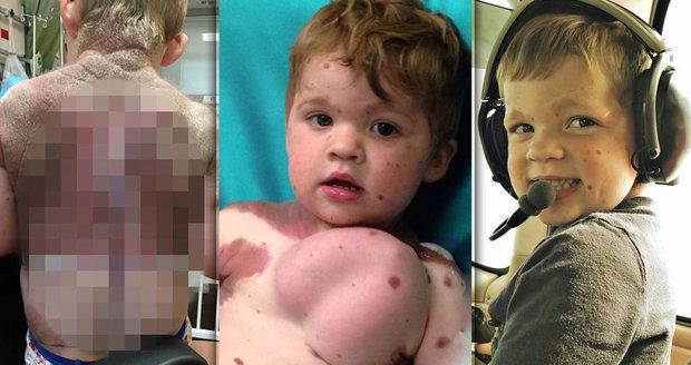 Chlapeček se narodil s děsivým znaménkem: Život mu zachránily prsní implantáty!
