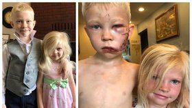 Šestiletý chlapec zachránil sestru před útokem psa. Na obličeji má 90 stehů!